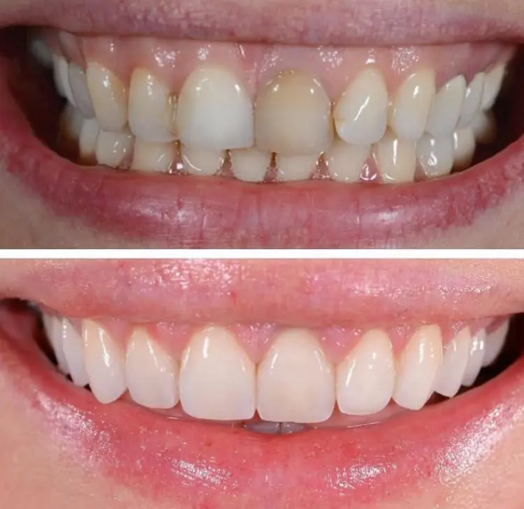 Before-After-Image-6