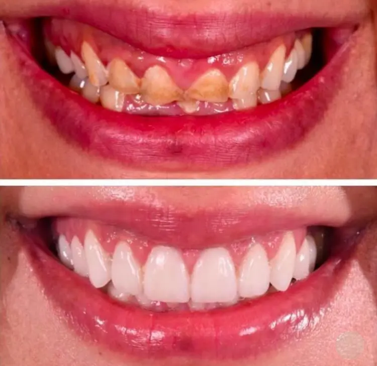 Before-After-Image-7
